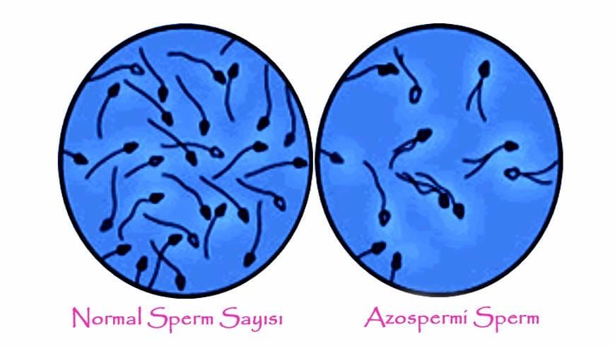 Azoospermia